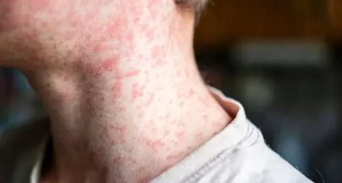 Primer plano del cuello y parte superior del pecho de una persona con una erupción cutánea roja y extendida. Se observan múltiples manchas rojizas y elevadas sobre la piel clara. La persona lleva una camiseta clara.
