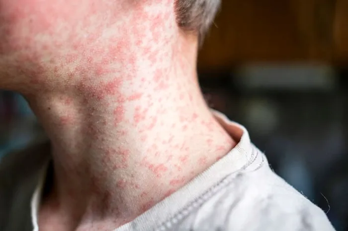Primer plano del cuello y parte superior del pecho de una persona con una erupción cutánea roja y extendida. Se observan múltiples manchas rojizas y elevadas sobre la piel clara. La persona lleva una camiseta clara.